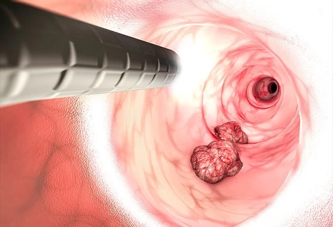 Here's a guide to colonoscopy screening in Singapore.